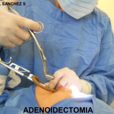 ADENOIDECT ADENOIDECT